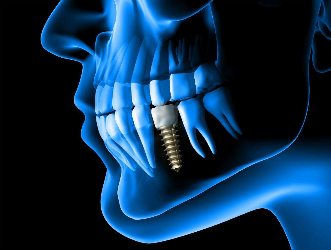 Dental Implants Saugus, MA