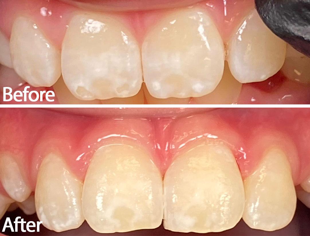 Before and After patient results from ICON smooth surface treatment at Saugus Smiles